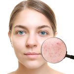 Acne can occur for various reasons