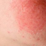 Аллергия на щеках