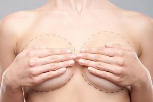 Augmentation mammoplasty - removal of breast implants