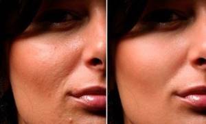 non-injection facial mesotherapy what is it?