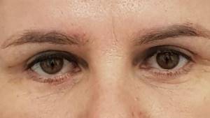 Eyelid blepharoplasty: revealing all the secrets with an expert