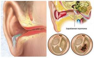 Boric acid in the ear is used by adults during pregnancy. The use of acid in the treatment of ears 