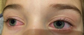 Частое моргание при аллергической реакции глаз