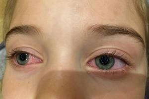 Частое моргание при аллергической реакции глаз