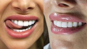 Что такое виниры и стоит ли их делать: задаем вопросы стоматологу