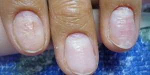 Deformed fingernails