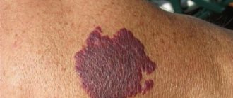 Фиолетовое пятно на коже