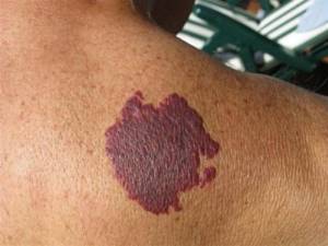Purple spot on skin