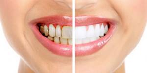 Фото зубов до и после винирования