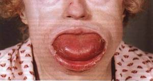 Known case of macroglossia in a woman