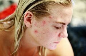 How to get rid of acne: the expert named the most reliable methods