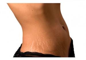 How to get rid of stretch marks on your stomach