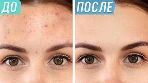 How to remove acne