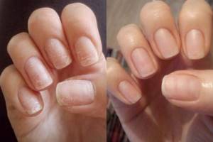 How to restore nails after gel polish