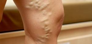 What does severe varicose veins look like?