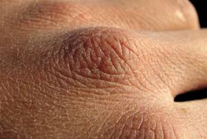 Каковы причины того, что сохнет кожа рук и что же делать в этом случае?