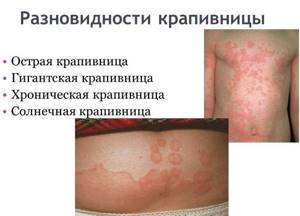 Red spots on a child’s body: rough, flaky, itchy, like bites, allergies, what to apply