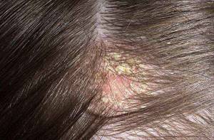 Treatment of the scalp after coloring
