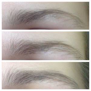 Treatment of sparse eyebrows