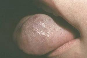 Macroglossia in thyroidism