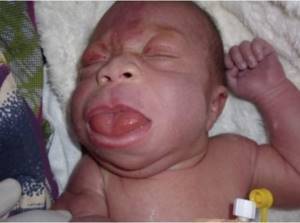 Macroglossia of the tongue in a child