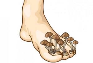 milk mushroom against onychomycosis of nails