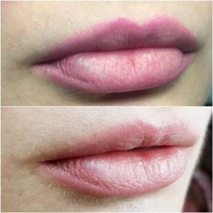 Is it possible to remove permanent lip makeup?