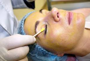 Application of acid during chemical peeling of the face