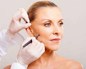 Thread facelift: advantages and disadvantages of the procedure, reviews from experts