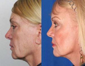 Thread facelift: advantages and disadvantages of the procedure, reviews from experts