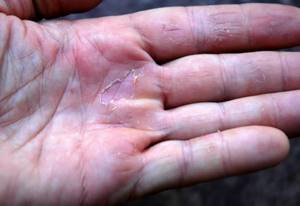 The skin of your hands is peeling: reasons and what to do?