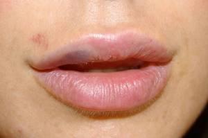 swollen lip from the inside