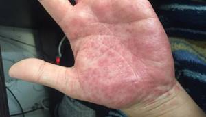The main causes of itching and red spots on the palms