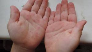 The main causes of itching and red spots on the palms
