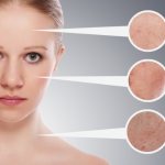 What causes pigment spots? Reasons and how to get rid of them. Treatment 