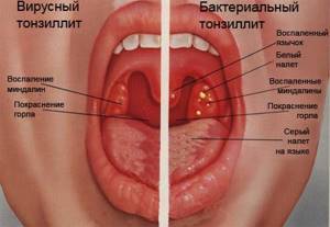 differences between viral and bacterial tonsillitis