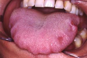 Teeth imprints on the tongue