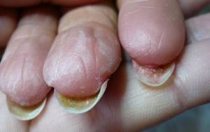 Why does skin grow under the nail?