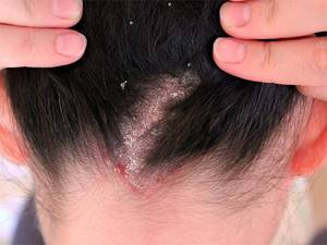 The use of folk remedies for lice can sometimes pose a serious threat not only to the scalp, but also to human health in general.