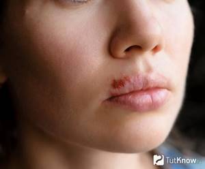 Colds as a contraindication for lip scrub