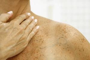 spots on the skin after a sunburn