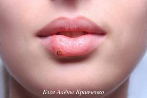 The wound on the lip does not heal for a long time. Where did the sore on your lips come from? How to treat it? Official medicine about ulcerative defects on the lips 