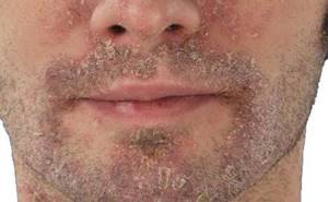 Peeling skin on face photo