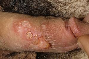 herpes symptoms
