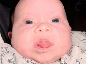 Down syndrome and macroglossia
