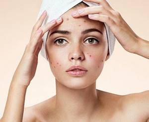 Ways to deal with rosacea on the face