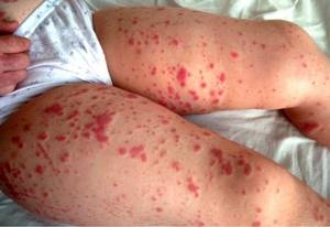 Rash on legs in the form of pimples photo