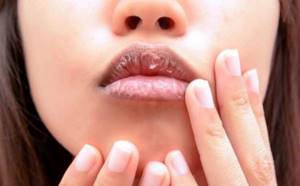 Трещины на губах — причины и лечение в домашних условиях