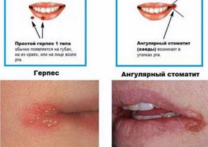 трещины в уголках губ причины и лечение