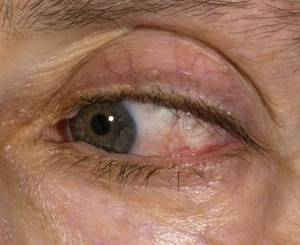 remove red blood vessels under the eyes